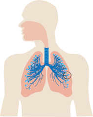 Le particelle granulose biopersistenti inalate si accumulano negli alveoli polmonari.